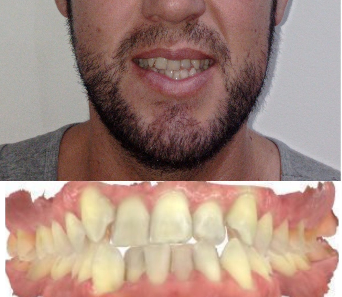 Antes - David